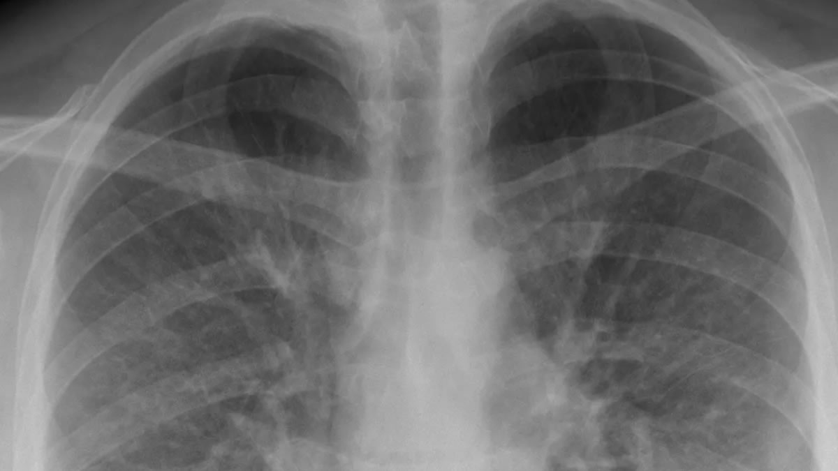 What is EVALI and How Do E-Cigarettes Cause Acute Lung Damage?